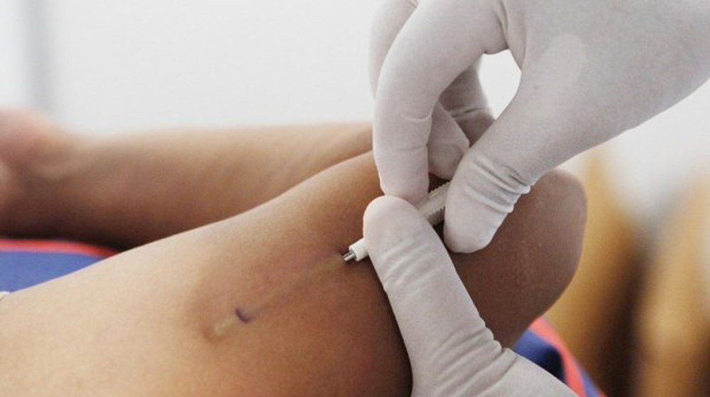 Cấy que tr&aacute;nh thai